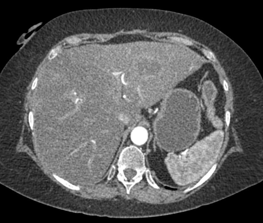 Prior Hematoma Left Lobe of the Liver - CTisus CT Scan