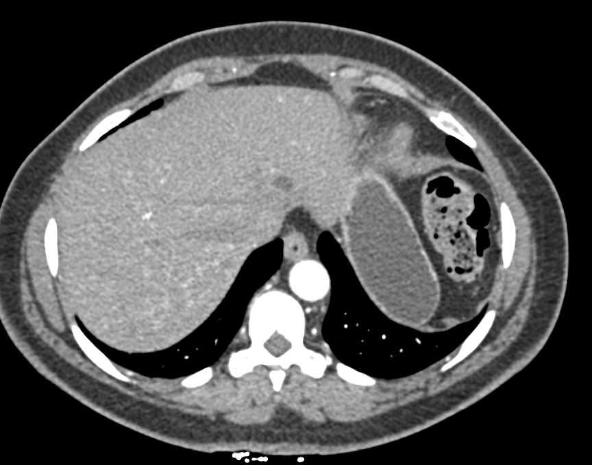 Metastatic Carcinoid Tumor to the Liver - CTisus CT Scan