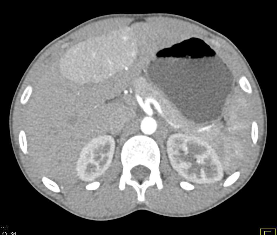 FNH (Focal Nodular Hyperplasia) Liver - CTisus CT Scan