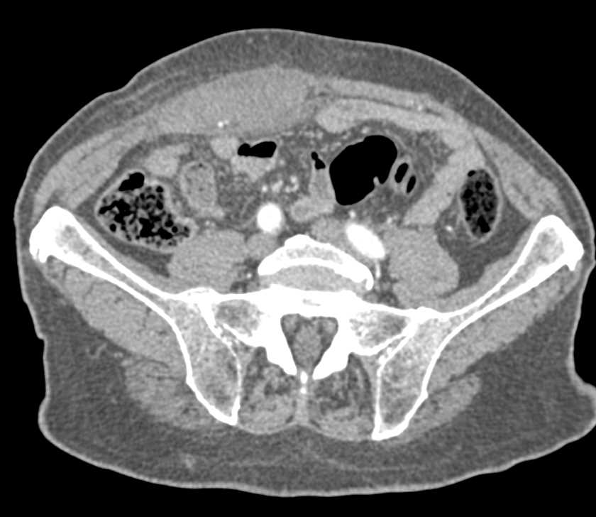 Hematoma in Rectus Muscle - CTisus CT Scan