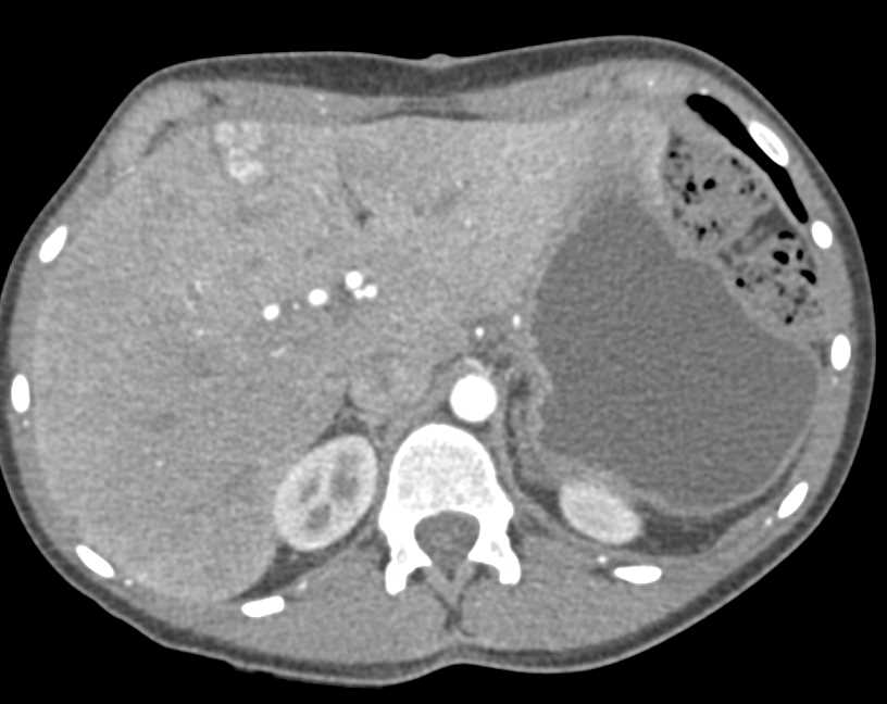 Vascular Fistulae Liver - CTisus CT Scan