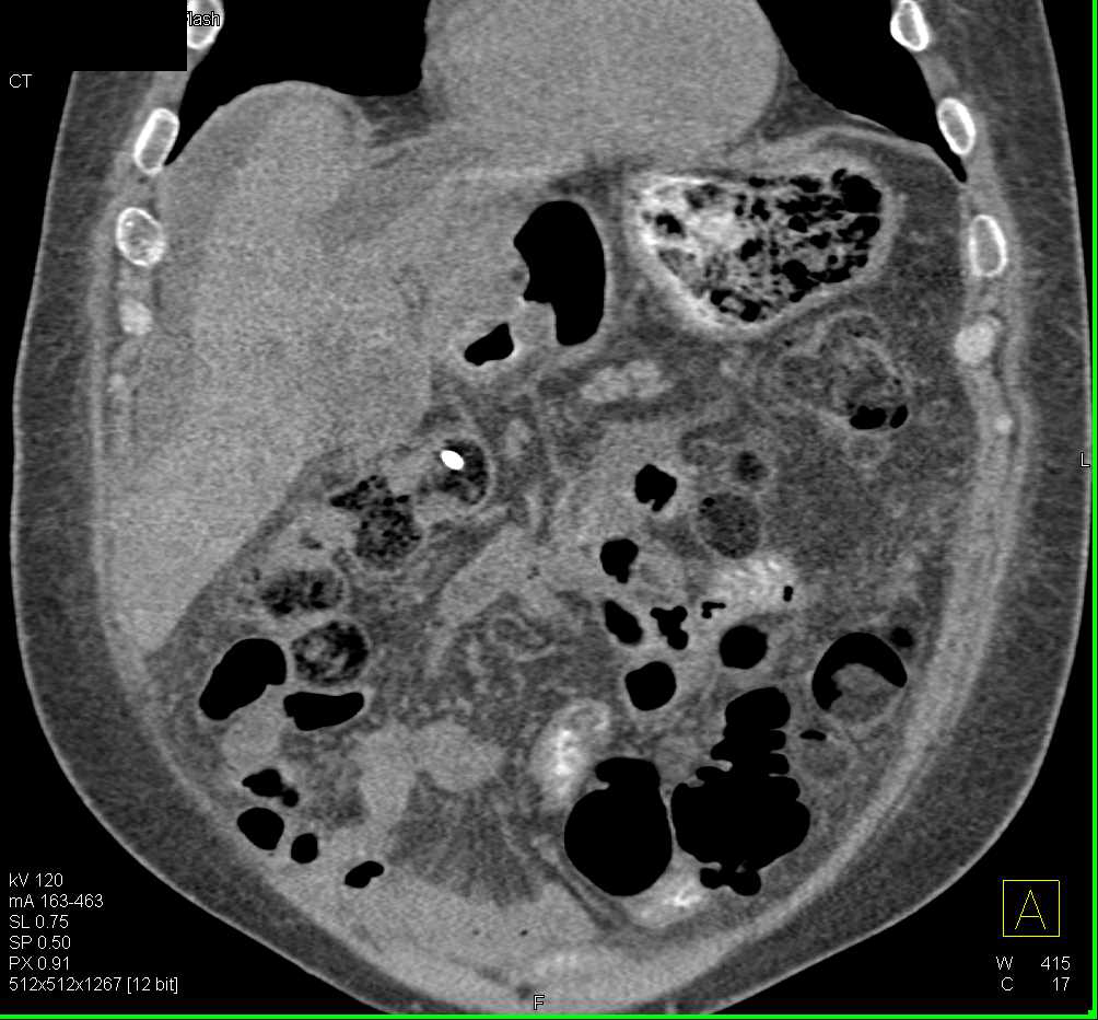 Liver Abscess s/p Stent Placement - CTisus CT Scan