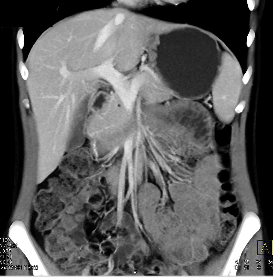 Focal Nodular Hyperplasia (FNH) Liver - CTisus CT Scan