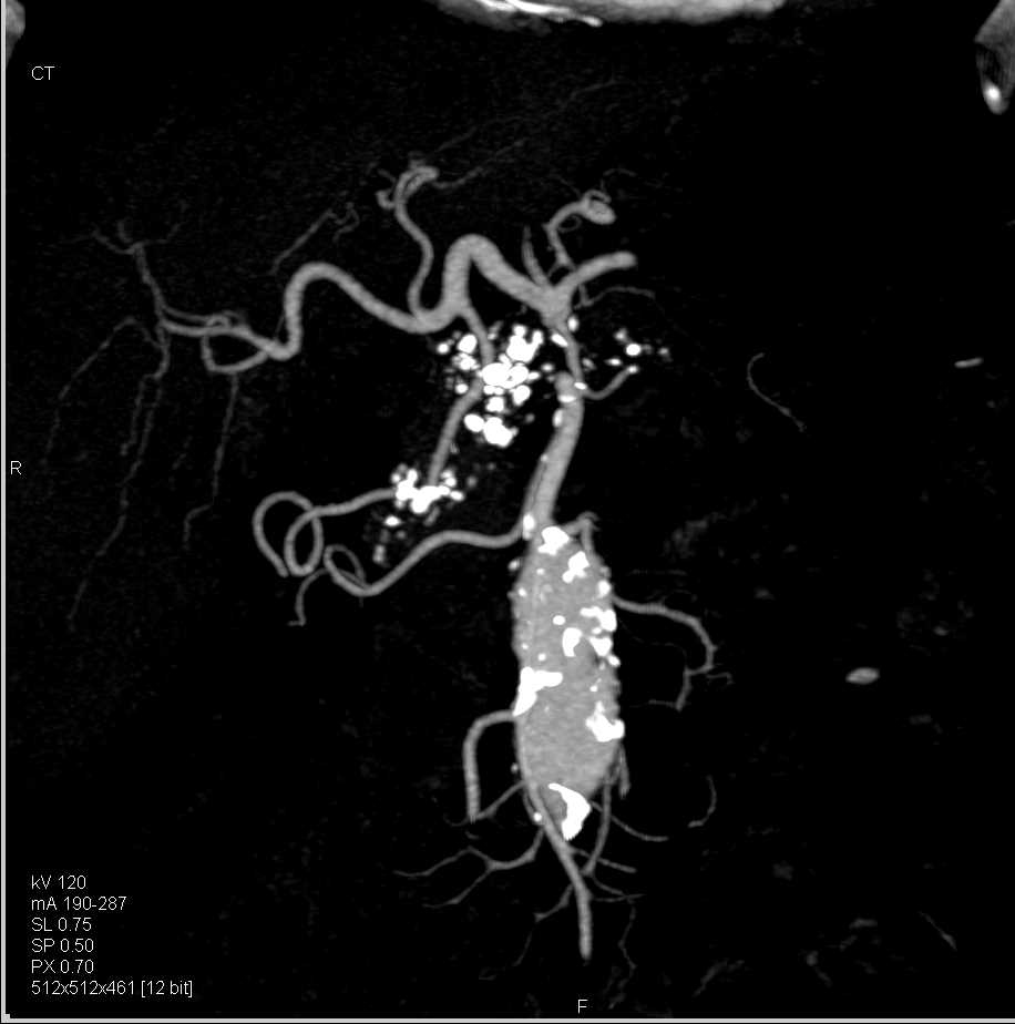 Unusual Neuroendocrine Tumor Head of Pancreas - CTisus CT Scan