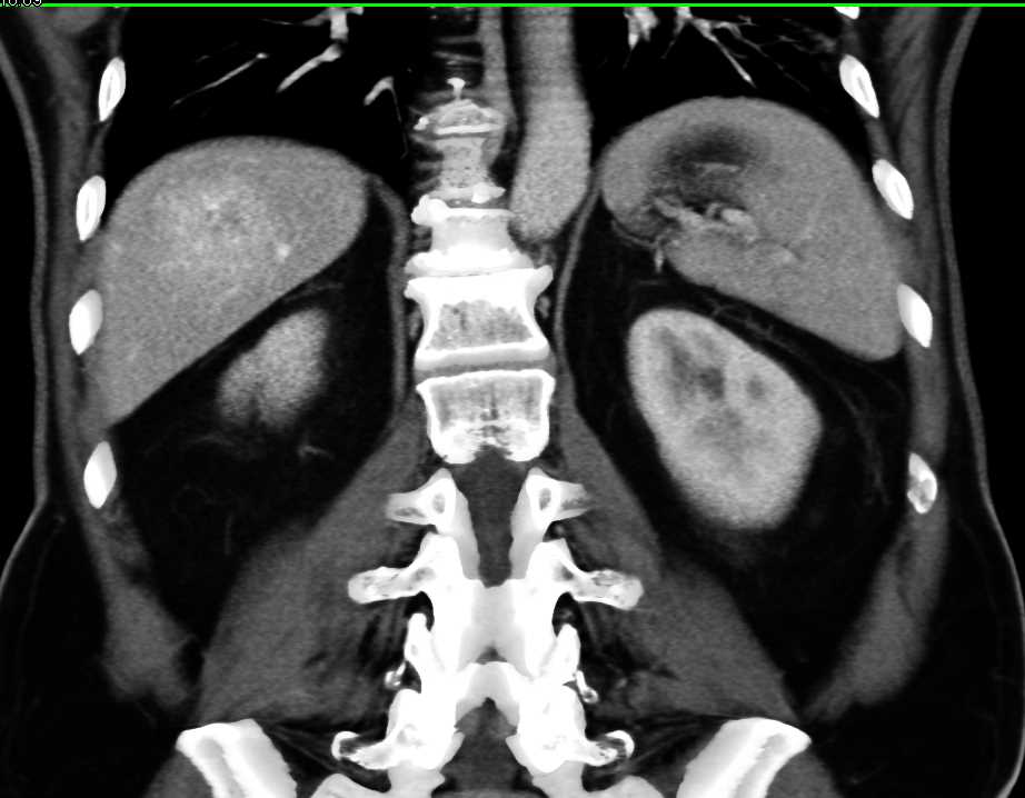 Hepatic Hemangioma - CTisus CT Scan