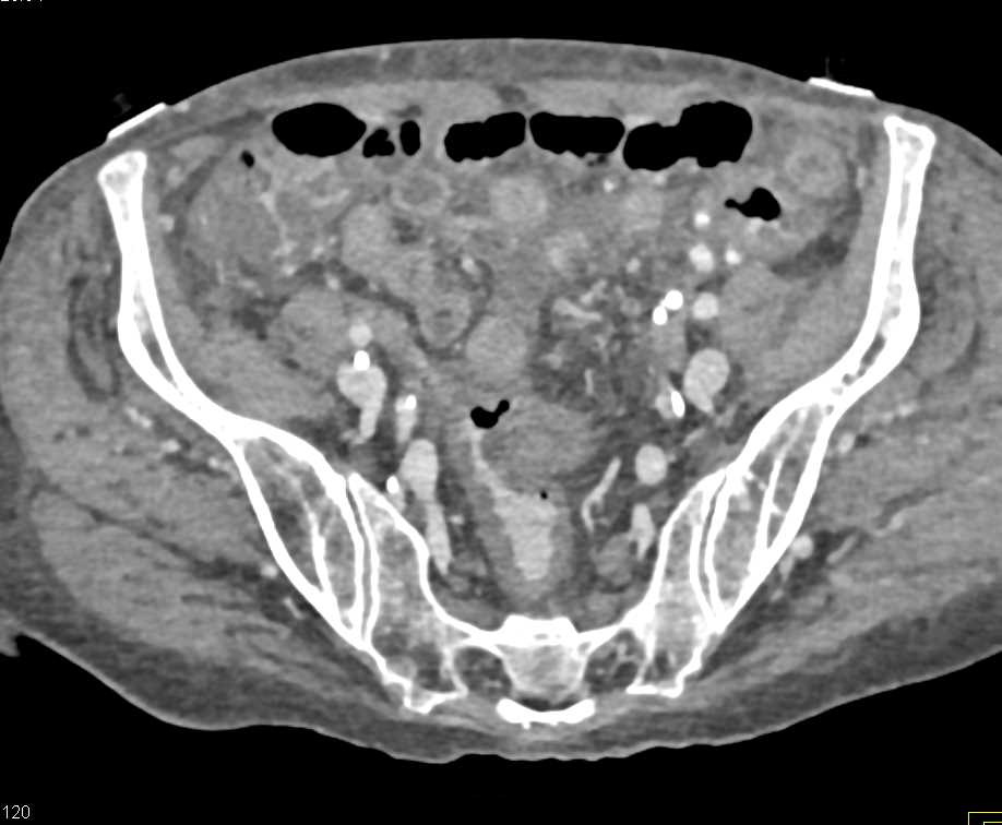 Embolization of an Arteriovenous (AV) Fistulae in the Liver - CTisus CT Scan