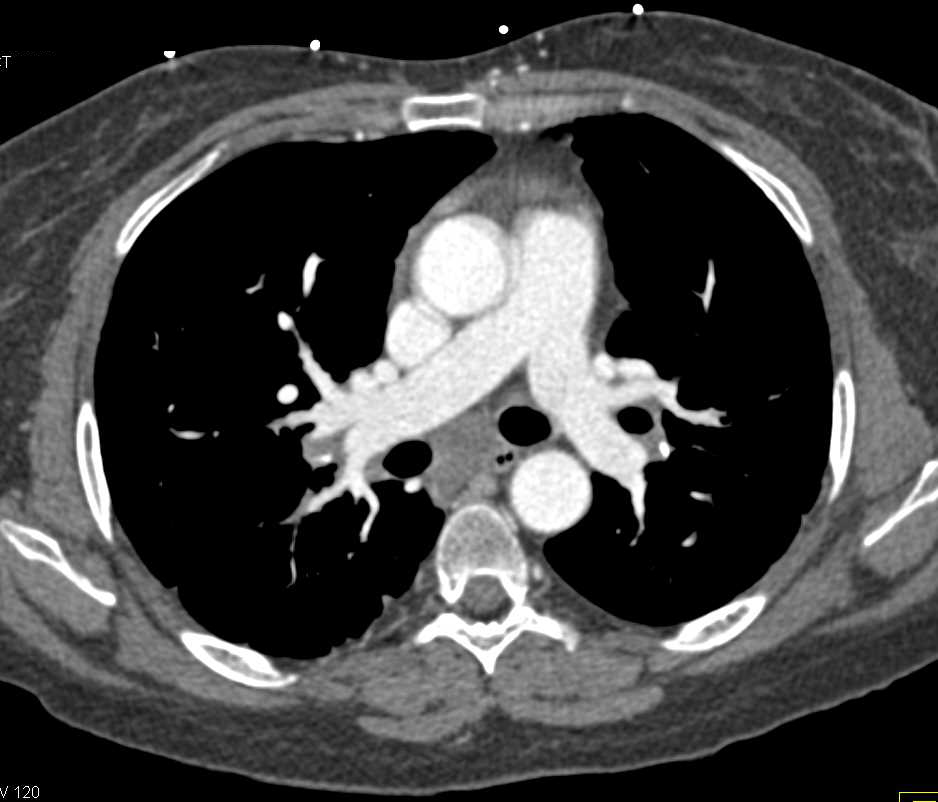 Lung Cancer with Liver Metastases - CTisus CT Scan