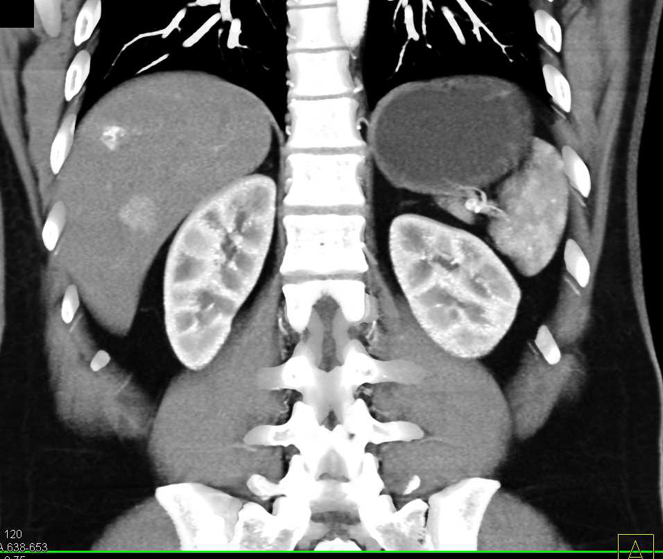 Hepatic Hemangioma and Focal Nodular Hyperplasia (FNH) - Liver Case ...