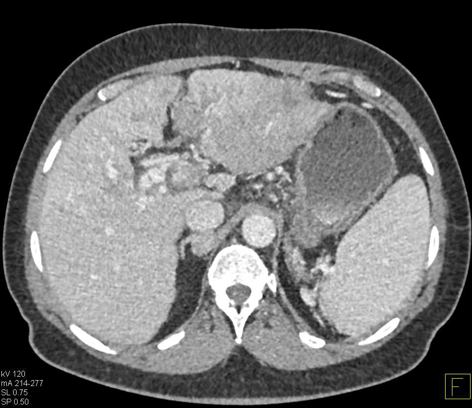 Hepatocellular Carcinoma (Hepatoma) with Arteriovenous (AV) Shunting and Portal Vein Involvement - CTisus CT Scan