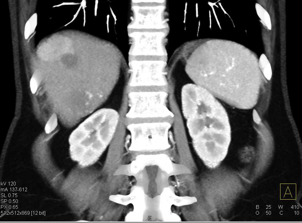 Hemangiomas and Focal Nodular Hyperplasia (FNH) - CTisus CT Scan