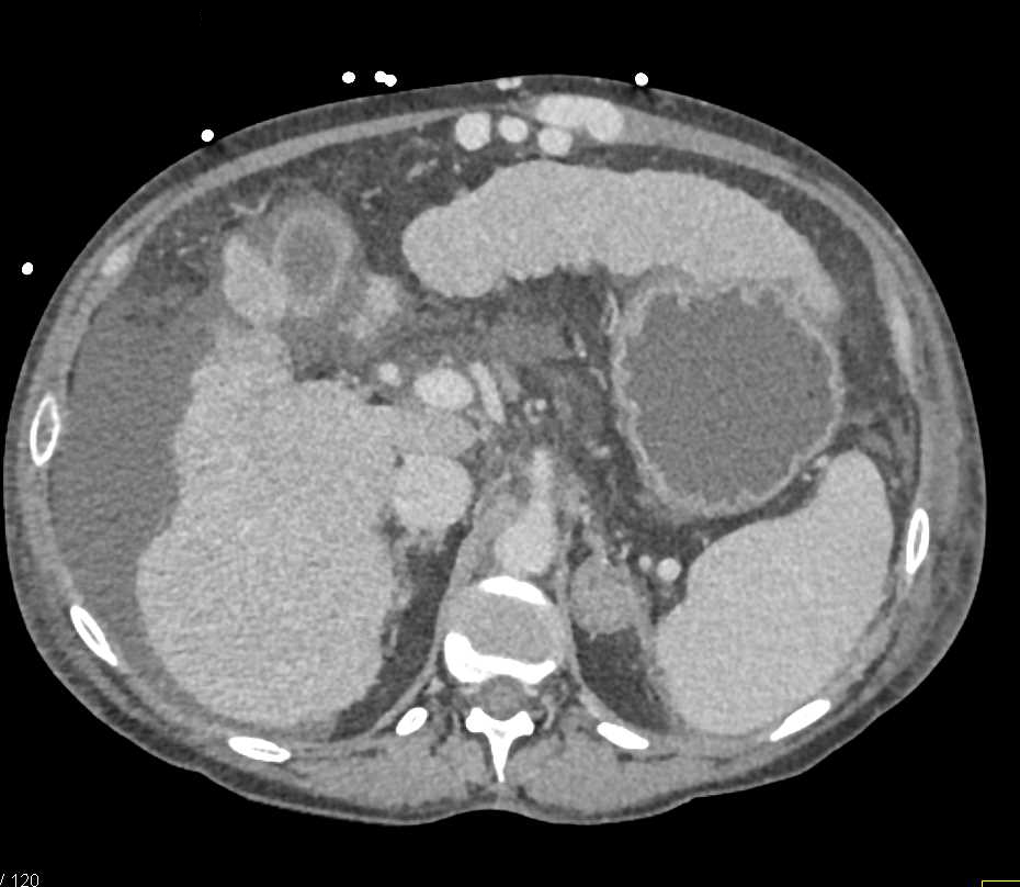 Cirrhosis with Inflamed Mesenteric Fat Left Upper Quadrant - CTisus CT Scan