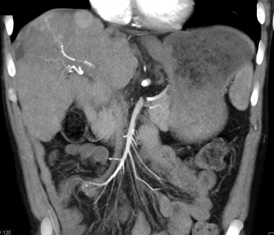 Gastrointestinal (GI) Bleed due to Large Rectal Varices with CTA in Patient with Portal Hypertension - CTisus CT Scan