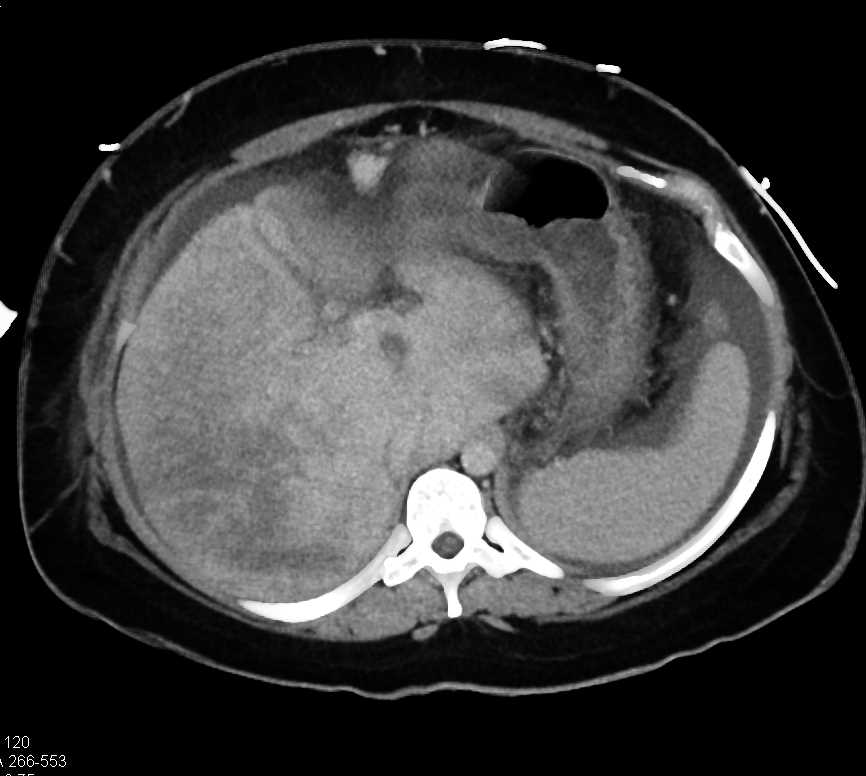 Budd-Chiari Syndrome - CTisus CT Scan
