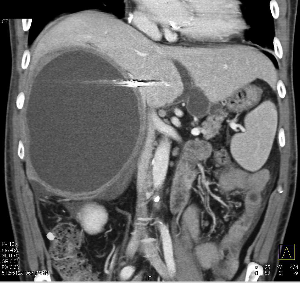 Hepatic Abscess - CTisus CT Scan