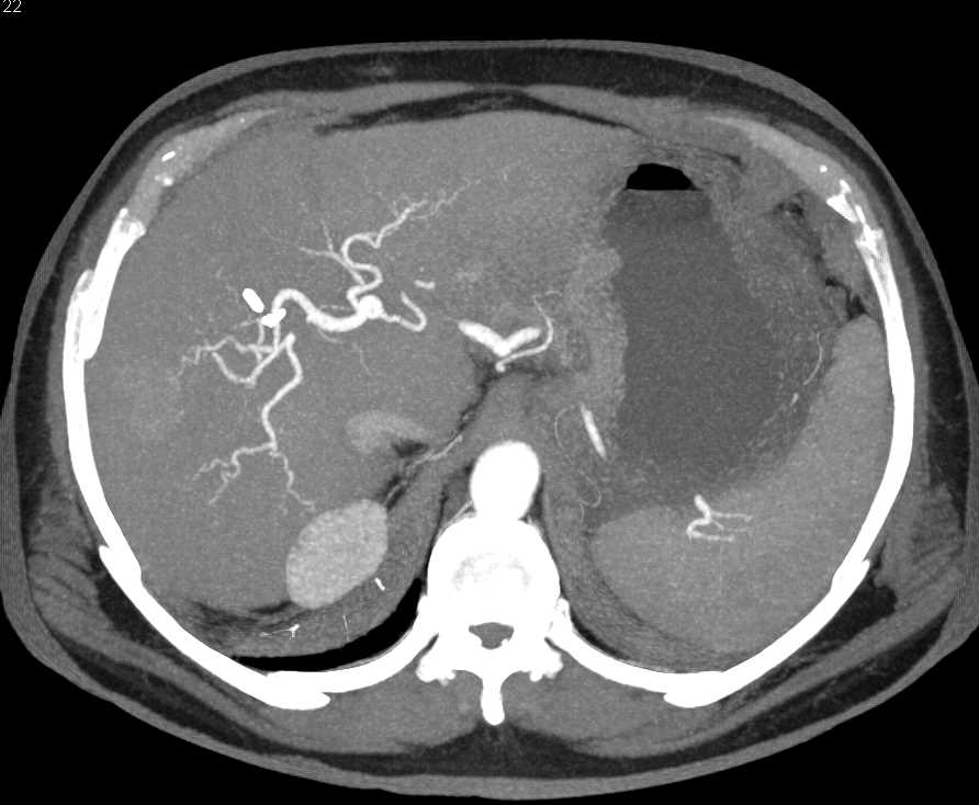 Vascular Lesion in the Right Lobe of the Liver - Liver Case Studies