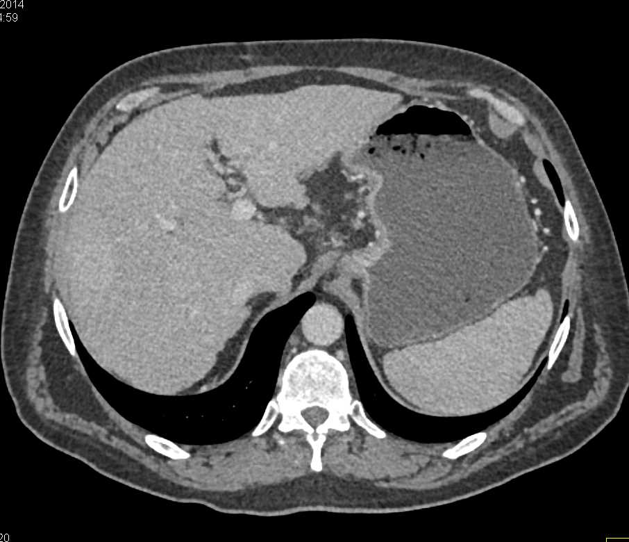 Vascular Lesion in the Right Lobe of the Liver - CTisus CT Scan