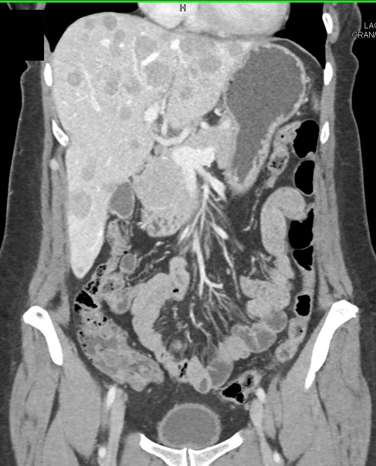 Metastatic Neuroendocrine Tumor to the Liver - CTisus CT Scan