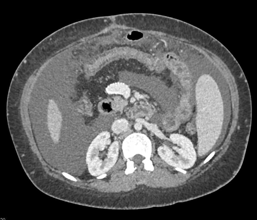 Portal Vein to Inferior Vena Cava (IVC) Stent in a Cirrhotic Patient - CTisus CT Scan