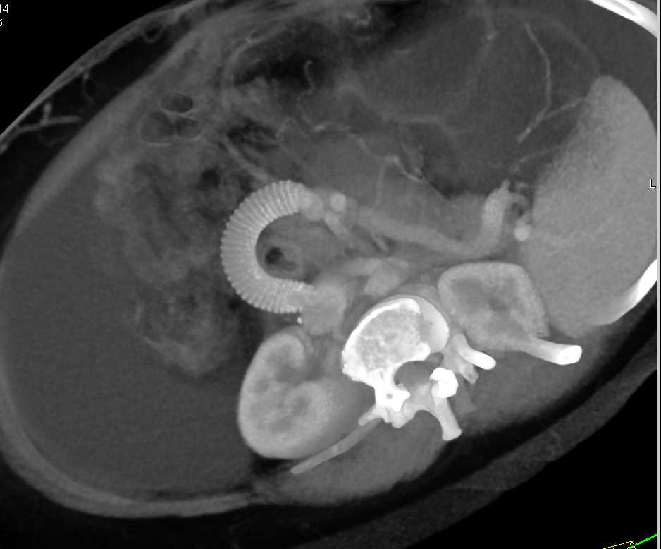 Cirrhosis with Portal Hypertension with Portal Vein (PV) to Inferior Vena Cava (IVC) Shunt - CTisus CT Scan