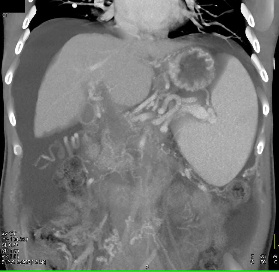 Cirrhosis and Portal Hypertension with Extensive Varices - CTisus CT Scan