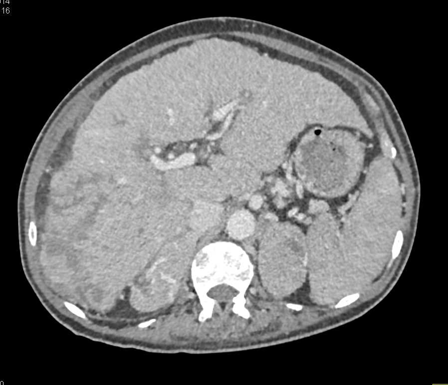 Hepatocellular Carcinoma (Hepatoma) rises in a Cirrhotic liver with Bone Metastases - CTisus CT Scan