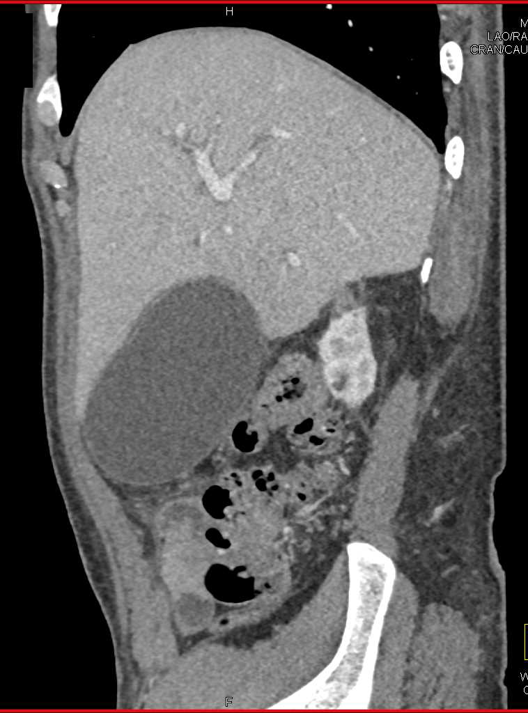 Distended Gallbladder - CTisus CT Scan