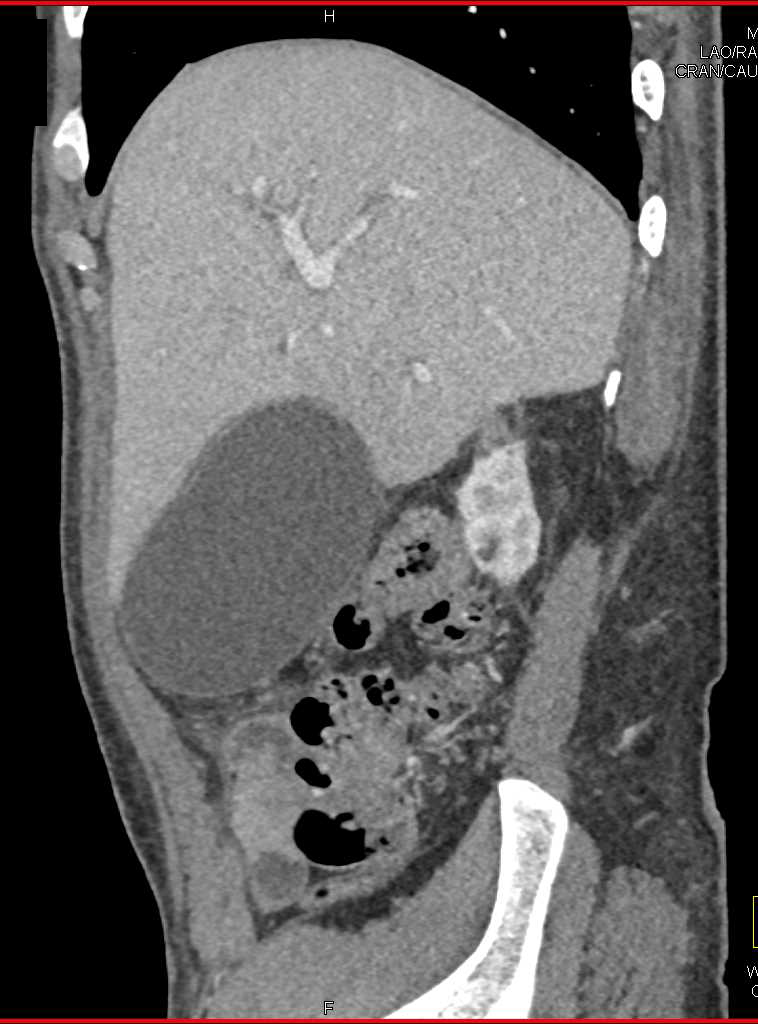 Distended Gallbladder - Liver Case Studies - CTisus CT Scanning