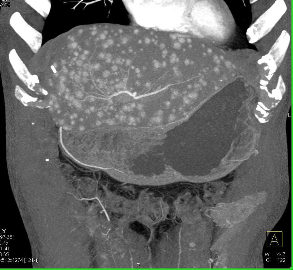 Recurrent Metastatic Neuroendocrine Tumor to the Liver Best Seen With MIP Images - CTisus CT Scan