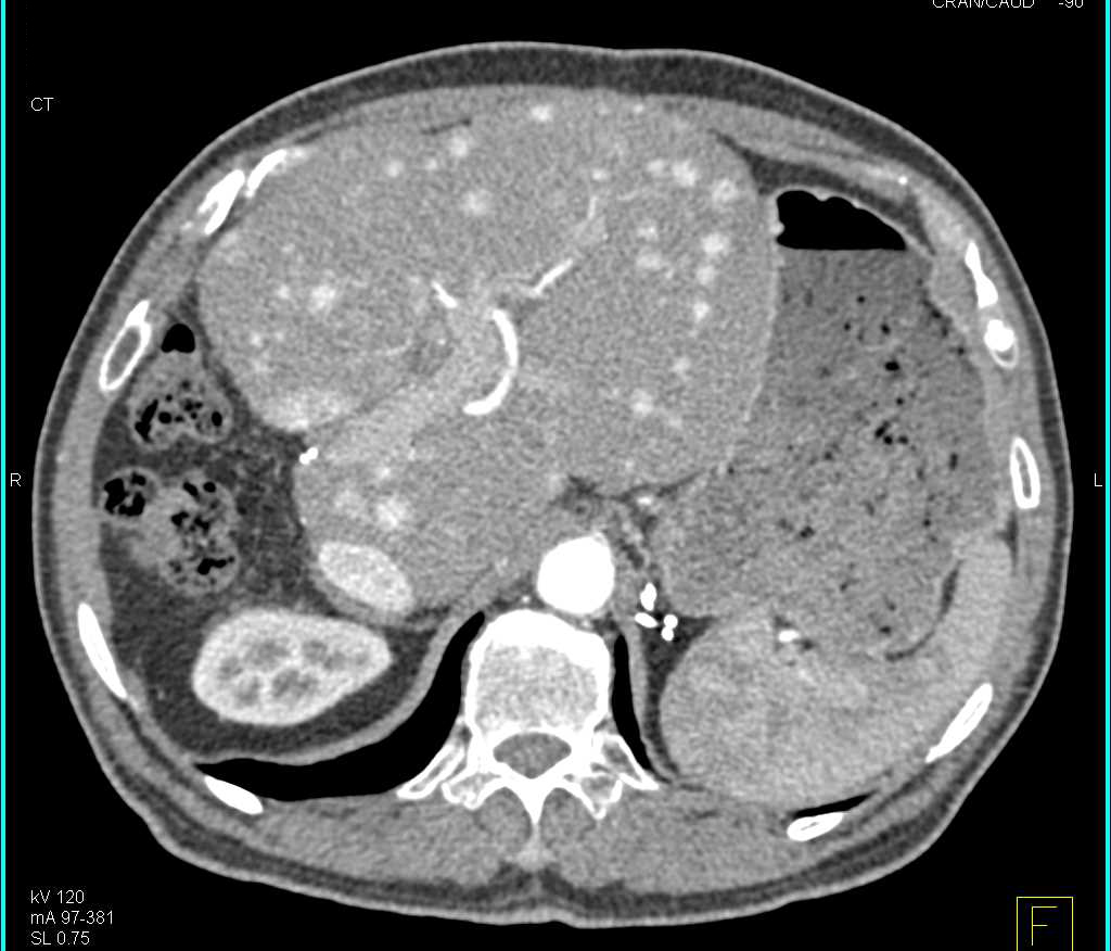 Recurrent Metastatic Neuroendocrine Tumor to the Liver Best Seen With MIP Images - CTisus CT Scan