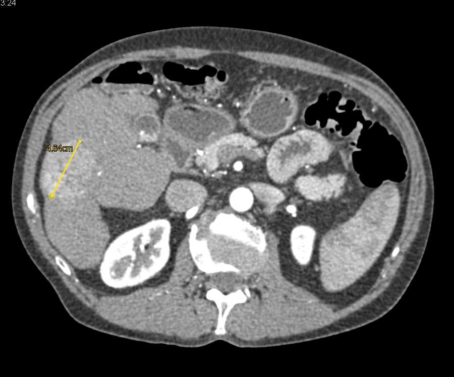 Hepatocellular Carcinoma (Hepatoma) with Neovascularity in a Cirrhotic Liver - CTisus CT Scan