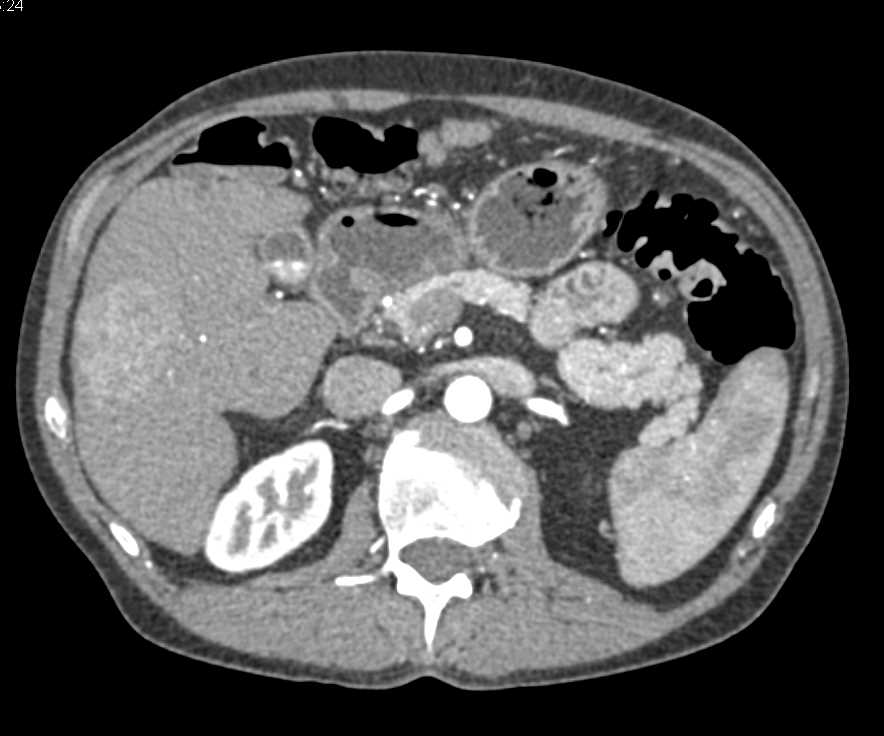 Hepatocellular Carcinoma (Hepatoma) with Neovascularity in a Cirrhotic Liver - CTisus CT Scan