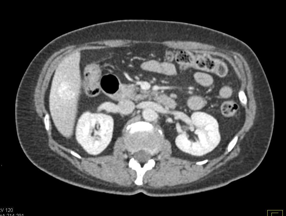 Focal Nodular Hyperplasia (FNH) Liver and Ovarian Cysts - CTisus CT Scan