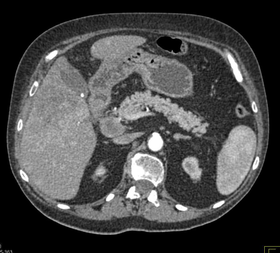 Cholangiocarcinoma of the Liver with Peripancreatic Adenopathy - CTisus CT Scan