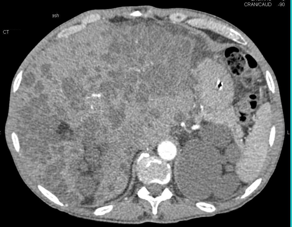 Polycystic Liver and Kidneys - CTisus CT Scan