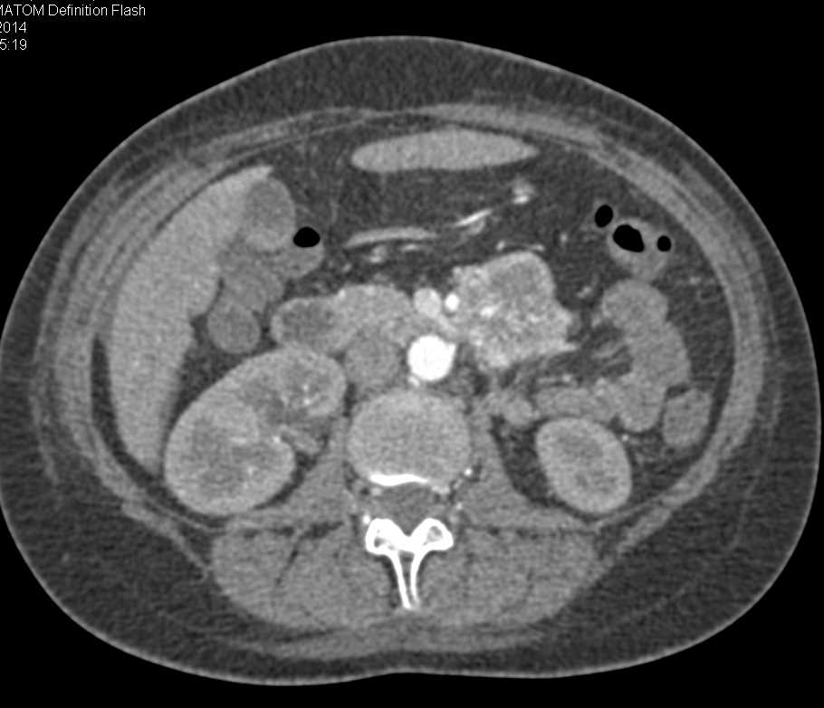 Liver Metastases from a Carcinoid Tumor - CTisus CT Scan