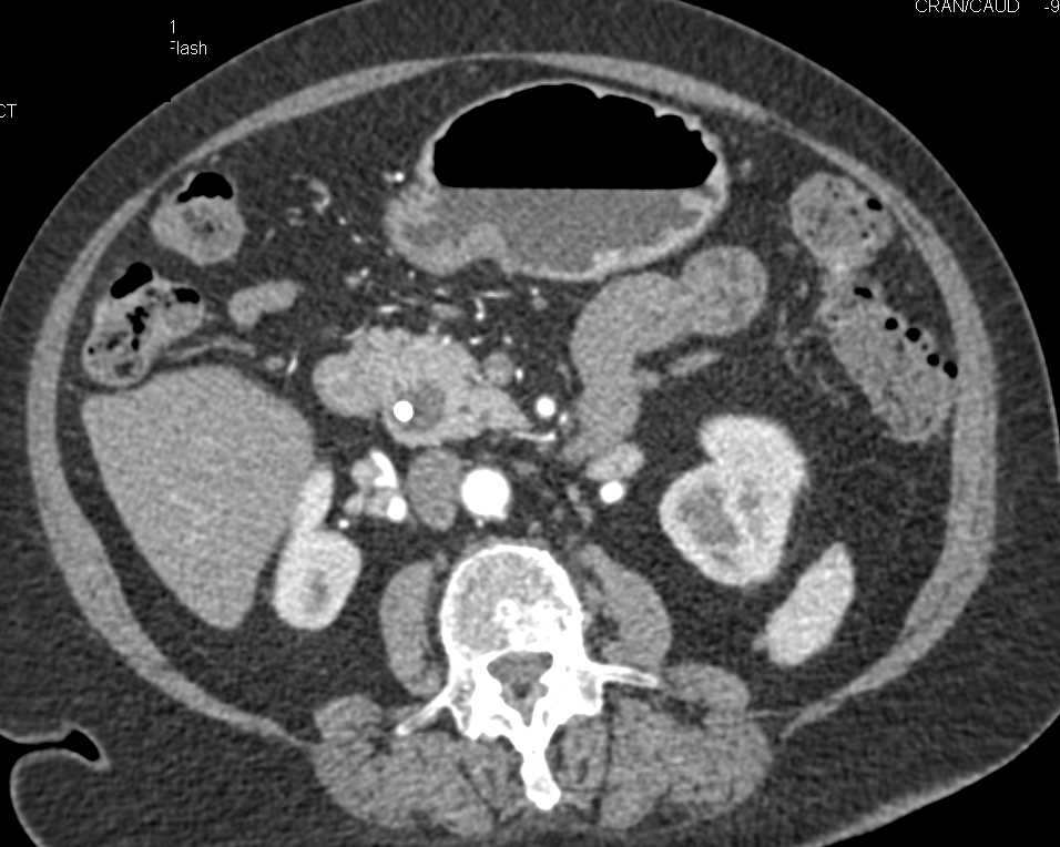 Focally Dilated Distal Common Bile Duct (CBD)  and Choledochocele - CTisus CT Scan