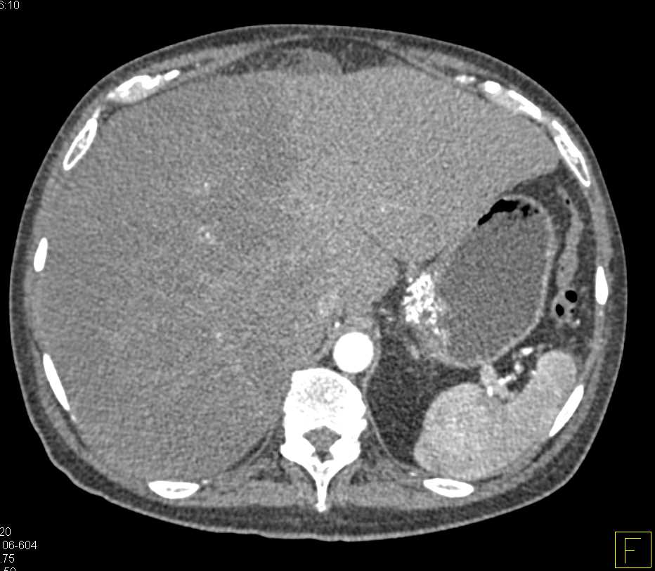 Infiltration Liver with Carcinomatosis - CTisus CT Scan