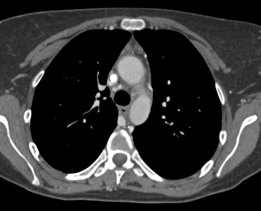 Subcapsular Fluid Collection in the Liver - CTisus CT Scan