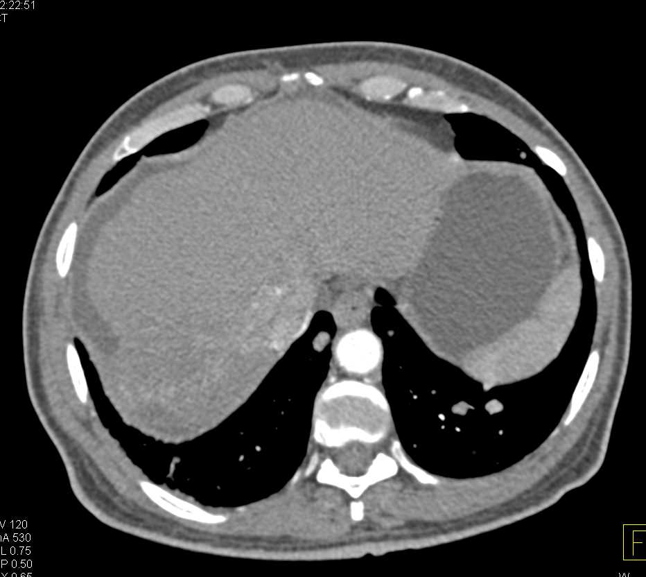 Hepatocellular Carcinoma (Hepatoma) Invades the Inferior Vena Cava (IVC) and Extends into the Right Atrium - CTisus CT Scan