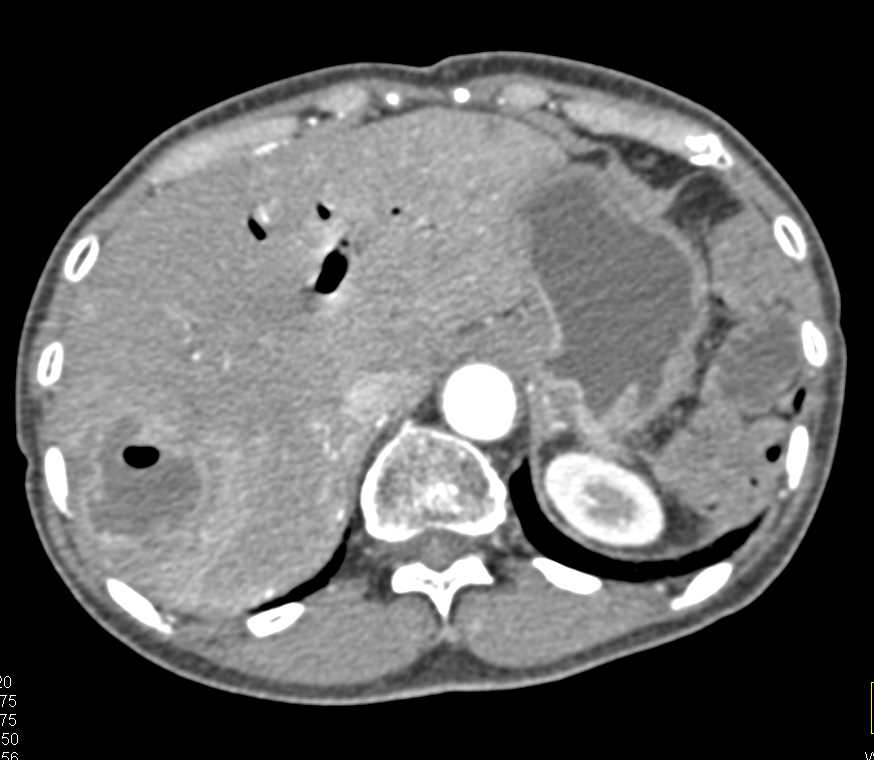 Liver Abscess in Oncology Patient with Common Bile Duct (CBD) Stent - CTisus CT Scan