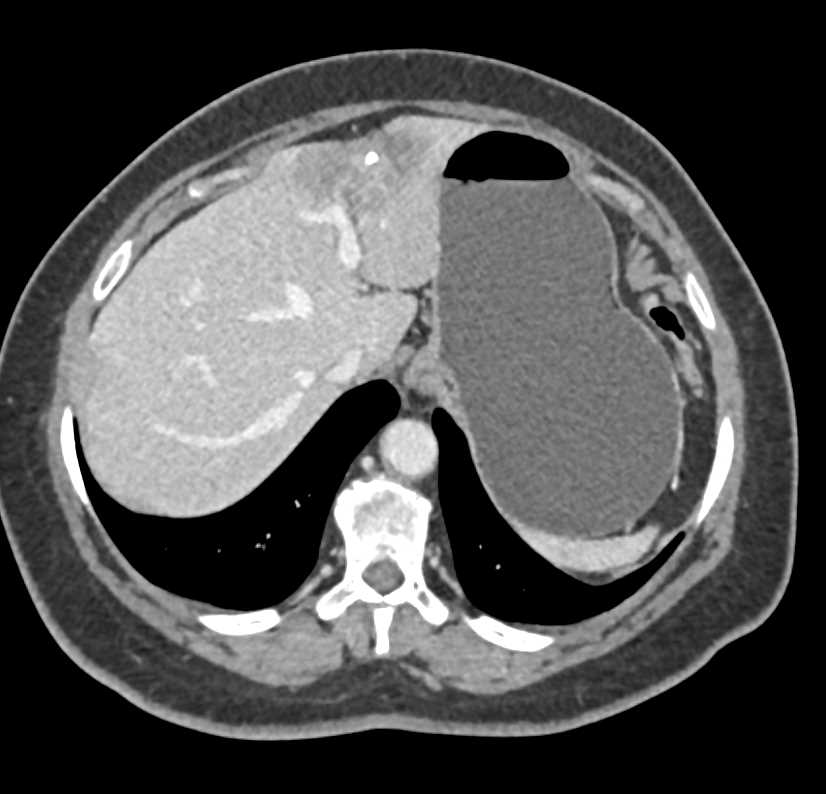 Resection of Cholangiocarcinoma of the Liver - CTisus CT Scan