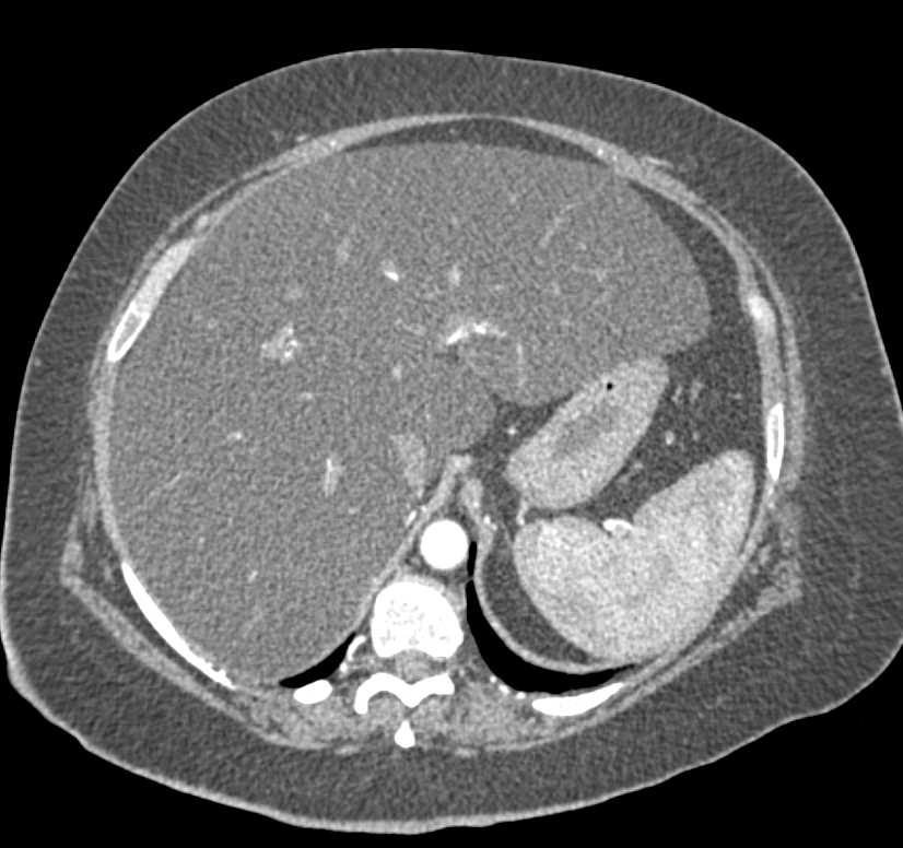 Right Gluteal Hematoma in a Patient with Fatty Liver Disease - CTisus CT Scan