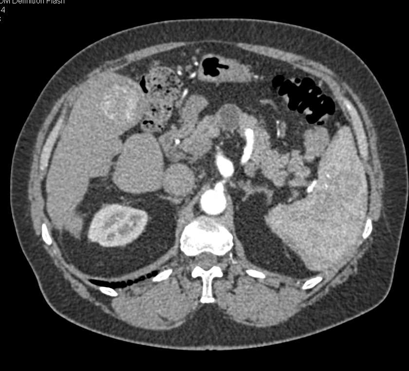 Metastatic Colon Cancer to the Liver - CTisus CT Scan