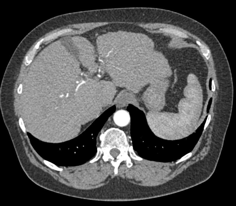 Metastatic Colon Cancer to the Liver - CTisus CT Scan