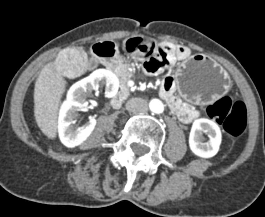 Hepatic Metastases off the Lower Right Lobe of the Liver - CTisus CT Scan