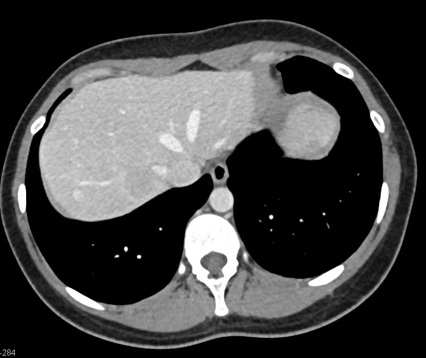 Multiple Focal Nodular Hyperplasia (FNH) in the Liver - CTisus CT Scan