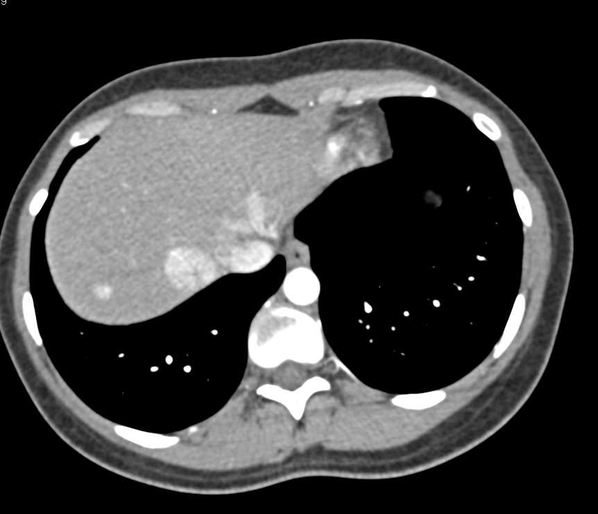 Focal Nodular Hyperplasia (FNH) Becomes Isodense on Later Phase Imaging - CTisus CT Scan