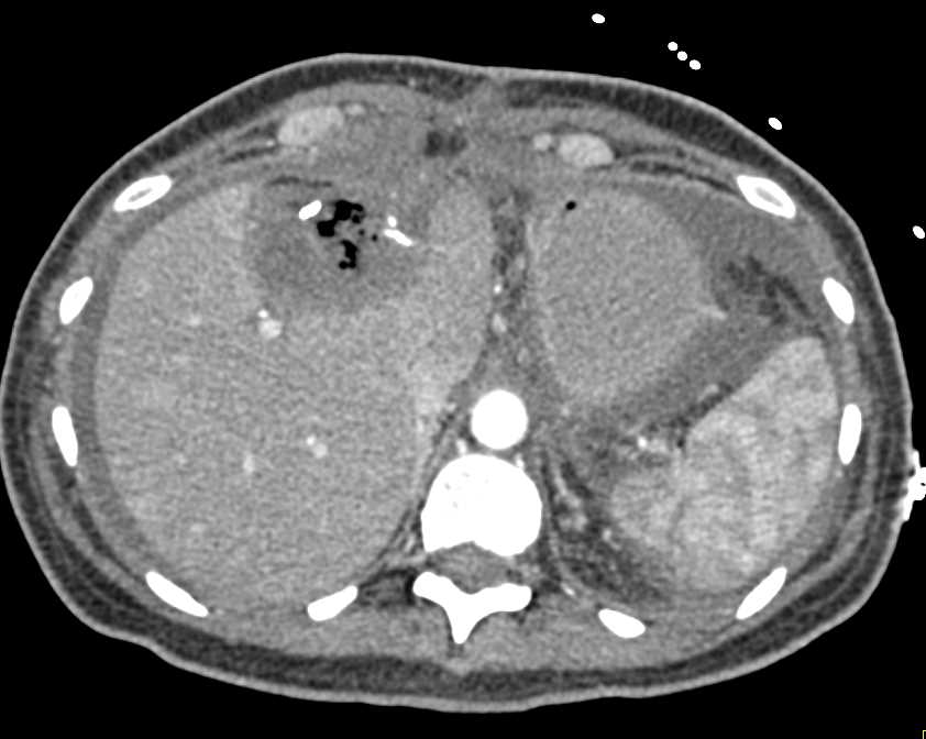 Serous Cystadenoma of the Liver - CTisus CT Scan