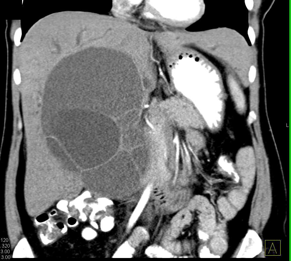 Serous Cystadenoma of the Liver - CTisus CT Scan