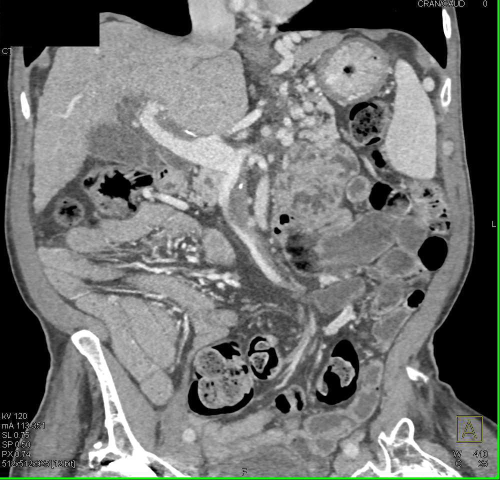 Cirrhosis with Partial Portal Vein Thrombosis (PVT) and Superior Mesenteric Vein (SMV) Thrombosis - CTisus CT Scan